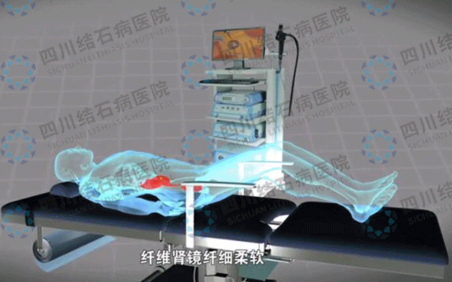 肾结石如何排出？(图5)