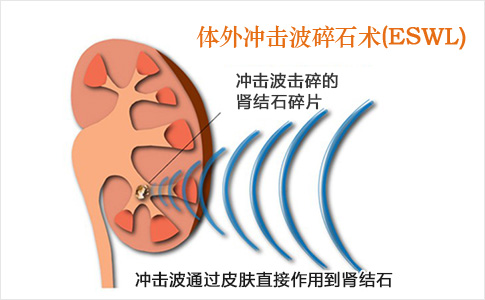 有肾结石要处理吗？多大需要手术？(图4)