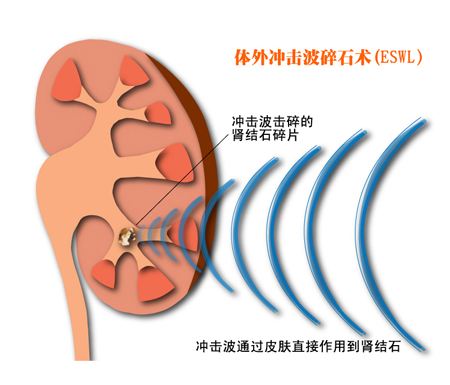 肾结石的检查方法有哪些？(图4)