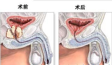 如何有效治疗前列腺增生？(图10)