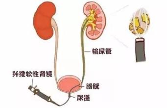 一次性给你们解答 关于肾结石碎石的疑问(图11)