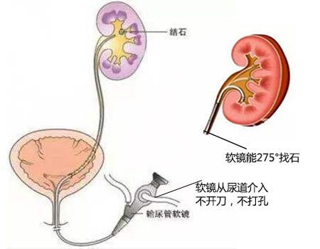 肾积水是怎么形成的？(图5)