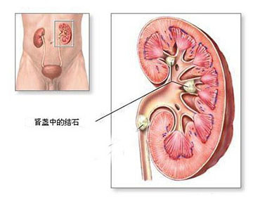 只需一分钟教你全面认识肾结石(图1)