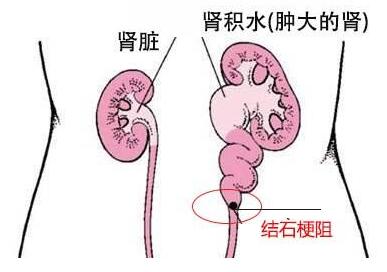 患者疑问：肾结石怎么治疗好？(图3)