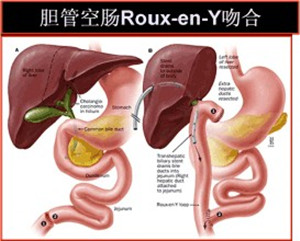 胆总管结石是如何形成的？(图1)