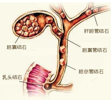 请正确认识胆结石！(图1)