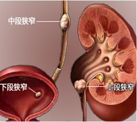 输尿管结石怎么排出？(图1)