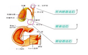 何为肝内胆管结石？(图1)