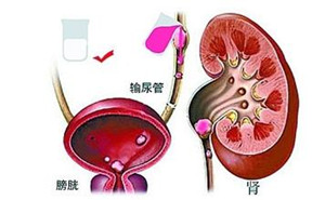 治疗输尿管结石需要多少钱(图1)