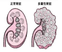肾囊肿是怎么形成的(图1)
