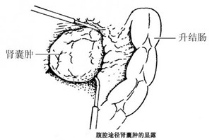 及时治疗肾囊肿 远离肾囊肿危害(图2)