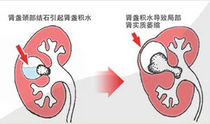 肾积水的危害有哪些？(图1)