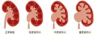 肾积水对身体有哪些危害?(图1)