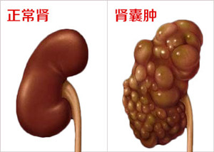 肾囊肿的病因有哪些?(图1)