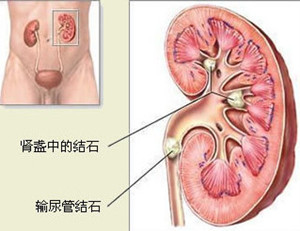 得了肾结石为什么会腰部绞痛？(图1)