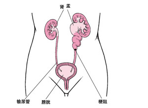 肾结石的危害大吗？(图1)