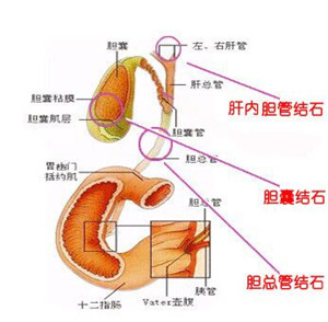 专家详解胆囊切除对人体的影响(图2)