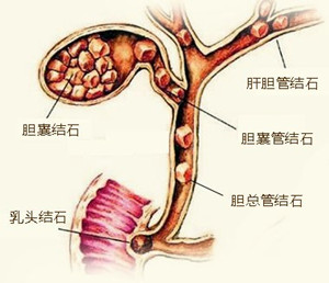 切除胆囊的危害(图1)