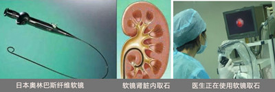 解析肾结石(图4) 解析肾结石(图4)