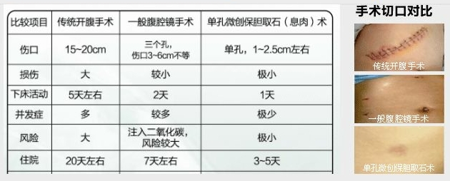 胆囊息肉多大时需要做手术？(图4)