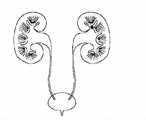 尿结石形成的因素是什么(图4) 尿结石形成的因素是什么(图4)
