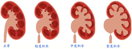 肾积水如何治(图1)