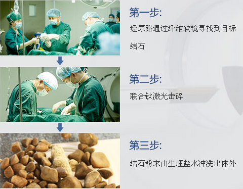 肾结石小便有血是怎么回事(图3)