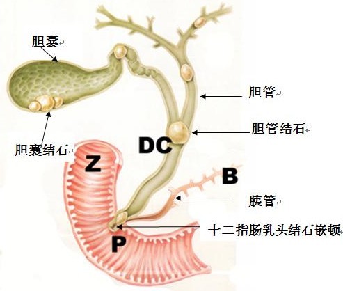 轻视胆结石，危害你真的承受不起！(图1)