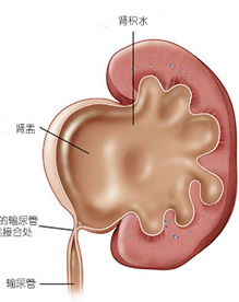 肾积水手术治疗(图1)