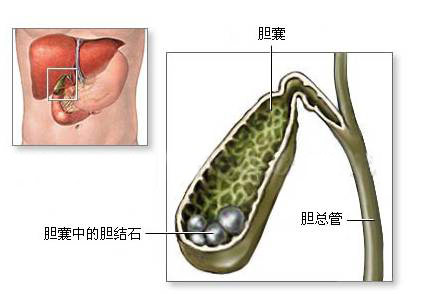 治疗胆结石有比切胆还好的妙招！(图2)