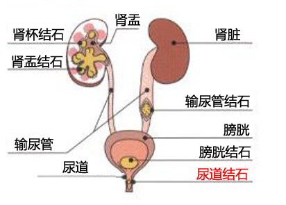 治疗膀胱结石哪家医院好？(图1)