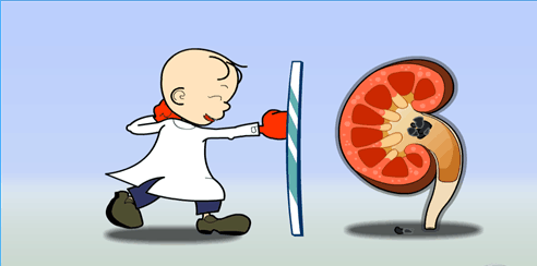 专家在线解答:输尿管结石碎石要多少钱(图3) 专家在线解答:输尿管结石碎石要多少钱(图3)