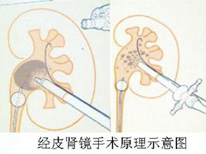 肾结石微创治疗让您的结石不再来(图3)
