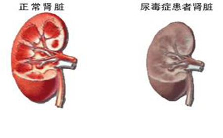 形成肾结石的原因是什么(图2)