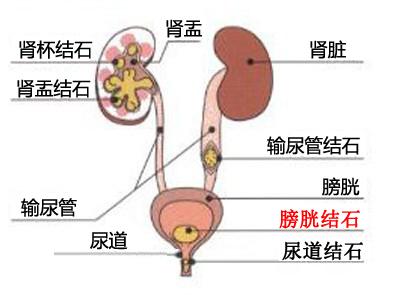 专家解析：膀胱结石的治疗方法(图1)