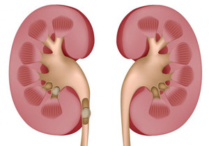 引起肾结石的原因是什么(图1)