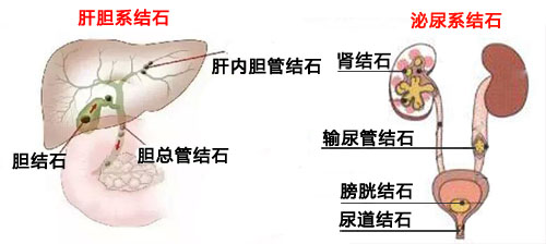 微创取石，保护器官功能，才是打结石的好方法(图1)