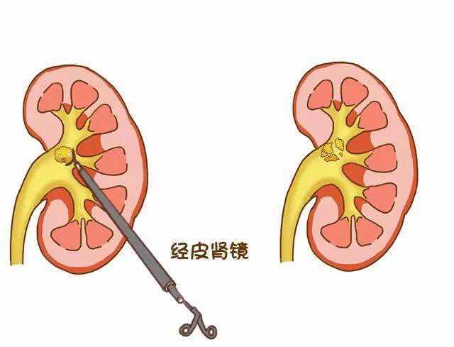 肾结石的检查方法有哪些？(图8)