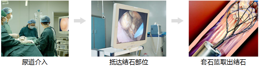 用这个方法打结石，安全、快速、高效！(图3)