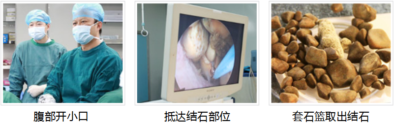用这个方法打结石，安全、快速、高效！(图2)