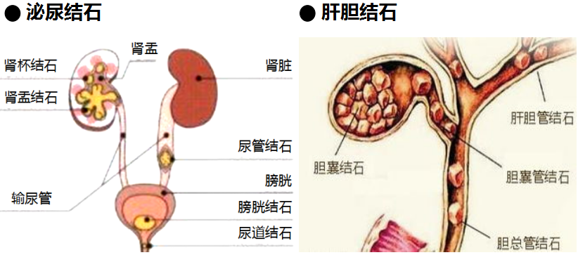 用这个方法打结石，安全、快速、高效！(图1)