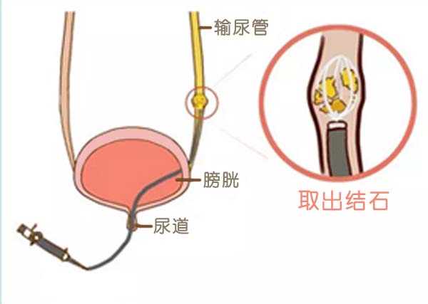 治结石，能保守不手术，能微创不开刀(图5)