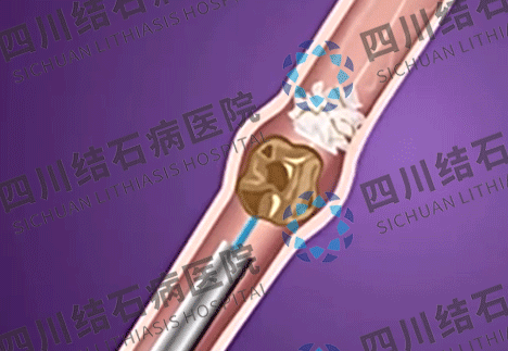 软镜取石，不开刀取净输尿管结石(图1)