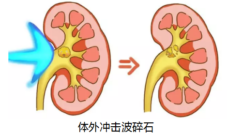 一次性给你们解答 关于肾结石碎石的疑问(图3)