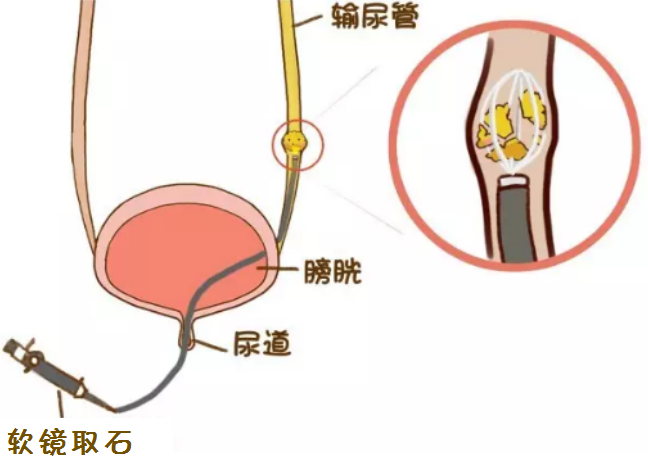 全面解析尿结石的各类手术(图2)