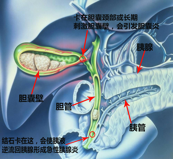 看了文章在决定，胆结石要不要手术！(图3)