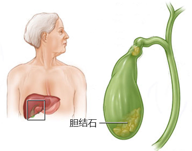 胆结石不一定要手术，但一定不能盲目乱治(图2)