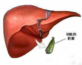 【详解】胆结石治法之一：胆囊切除手术(图3)