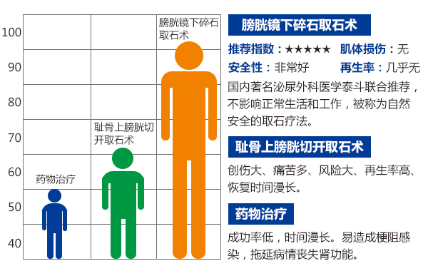 膀胱镜：微创治疗膀胱结石(图2)