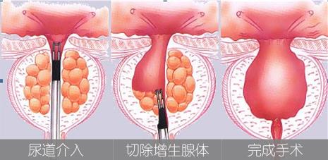 前列腺低温等离子汽化电切术：安全快速治疗前列腺增生(图1)